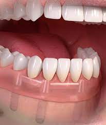 Fix fogsor: a megbízható, tartós, kényelmes kivehető fogsor - Dentpoint