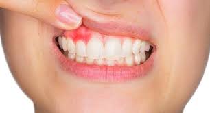 اسباب خراج الاسنان تخلص من الم خراج الاسنان واعرف اسبابه احاسيس بريئة