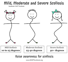 Pin On Scoliosis Living With Chronic Pain