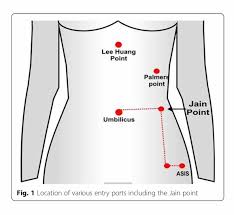 Palmer point features more than 260 feet of waterfront access on fourth lake. Cirbosque Some4surgery On Twitter Location Of Various Safe Entry Ports Points During Laparoscopic Surgery The Gynecological Surgery Experience Some4surgery Juliomayol Swexner Pferrada1 Almagoch Misirg1 Deliacortesguir Samatallahmd