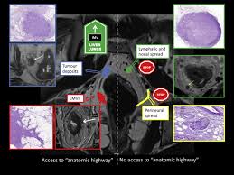 The symptoms of advanced bowel cancer can include the symptoms for bowel cancer that hasn't spread. Pathways Of Spread In Rectal Cancer A Reappraisal Of The True Routes To Distant Metastatic Disease European Journal Of Cancer