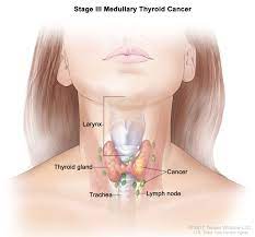 Endocrine Surgery Thyroid Cancer