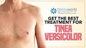 Tinea versicolor is a common fungal skin infection caused by yeast on the skin. Get The Best Treatment For Tinea Versicolor Youtube