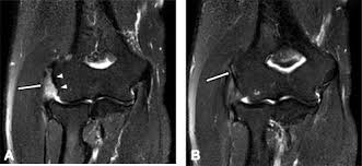 Pain upon resisted wrist extension. Magnetic Resonance Imaging Of Patients With Lateral Epicondylitis Relationship Between Pain And Severity Of Imaging Features In Elbow Joints Sciencedirect