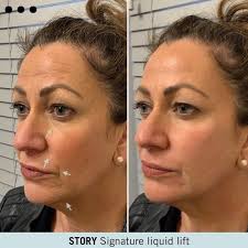 💉Anti-wrinkle Treatment is such a simple yet effective treatment that most  people don't even feel as you can see here 🎥 ——————————————————————————-  It...