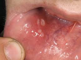 Image result for Canker sores symptoms roof of the mouth