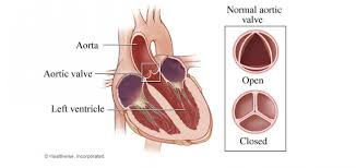 A donor valve can be expected to last 10 to 20 years. Aortic Valve Repair