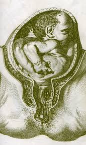 Umbilical Cord Prolapse Wikipedia