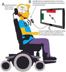 Formed in 1998, the band is composed of singer julian casablancas, guitarists nick valensi and albert hammond jr. The Current State Of Electrocorticography Based Brain Computer Interfaces In Neurosurgical Focus Volume 49 Issue 1 2020