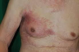 There may be areas that are skin color, pink, red, or very dark with a blue or purple tinge. A Case Of Male Inflammatory Breast Cancer Springerlink