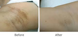 Laser hair removal removes hair a deeper level through exposure to pulses of laser light that destroy the hair follicle and prevent regrowth. Intimate Lightening David Ghozland M D