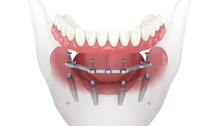 The biomechanical architecture of a full-arch All-on-4 restoration system., AI generated
