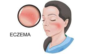 First, you need to identify and avoid the. How To Treat Eczema Causes Symptoms Prevention 5 Different Types Skinkraft