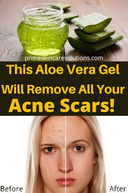 Pin On Natural Remedies Skin