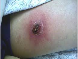We did not find results for: Spider Bites Injuries And Poisoning Msd Manual Consumer Version
