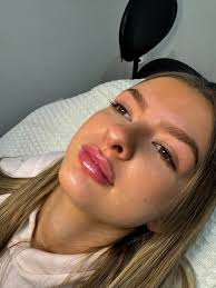 Looking for lip filler models🥰 Comfortable in front of the camera✓  Comfortable with the procedure✓ Lip filler doesn't always have to look fake  can also look completely natural when not overfilled, During