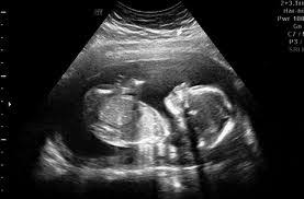 Kebanyakan pasangan mahu mengetahui jantina bayi mereka dan… Gambar Scan Baby Perempuan Wanita Cantik Buat Quotes