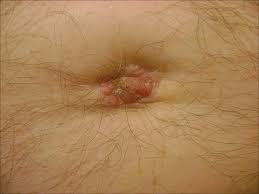 Image result for Umbilicus