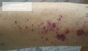 0.113 gi perforation / obstruction 0.060 0.663: Sepsis Facharztwissen