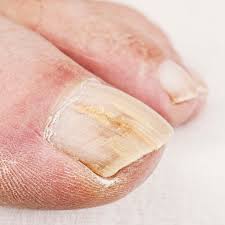 Is tea tree oil a safe and effective treatment for nail fungus? Topical Treatment Options For Toenail Fungus