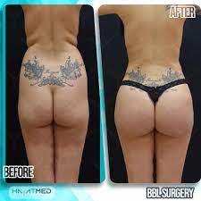 Since your body will reabsorb the fat in time, this means additional $5,000 to $10,000 for repeat surgeries. Fat Transfer To Hips Procedure Recovery And The Price