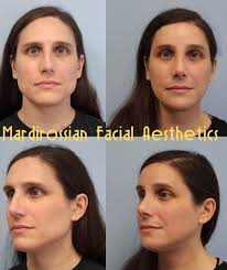 Facial Feminization Surgery Ffs West Palm Beach Fl Jupiter Ffs Facial Feminization Surgery Facial Facial Surgery