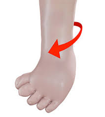 Image result for In-Toeing