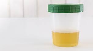 Bei rot gefärbtem urin war es vielleicht einfach nur die rote bete, die sie tags. Blut Im Urin Hamaturie