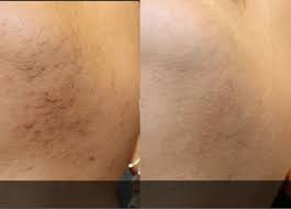 If you want to feel the difference that laser hair removal before and after can make in your life, feel free to. Back Laser Hair Removal Ei Con Health Wellness Center