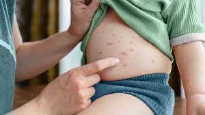 Image result for Urticaria pigmentosa children