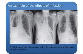 Pleural mesothelioma external beam radiation therapy steps. A Shows The Chest X Ray Of A Mesothelioma Patient With A Trapped Lung Download Scientific Diagram