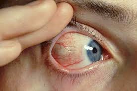 Image result for Scleritis