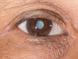 Look for a color change in the pupil. The Truth About Cataracts 8 Things