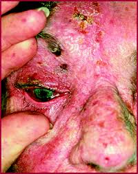 Image result for herpes zoster