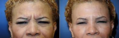 Most doctors who administer botox agree that a typical botox treatment should last for up to 3 to 4 months. Lauri Kane Answers Question Regarding How Often To Get Botox Injections Dr Dean Kane