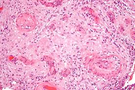 Raskausmyrkytys – Wikipedia