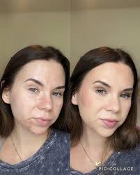 Michael Jackson's Acne Struggle and Its Impact