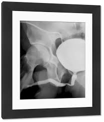 Image result for Voiding Cystourethrogram