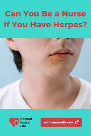 Herpes infections are most contagious when symptoms are present but can still be transmitted to others in the absence of symptoms. Can You Be A Nurse If You Have Herpes With 3 Facts About It