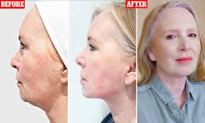 Hair experts' tips are added to help you through this journey. Woman Looks Ten Years Younger After Undergoing New Non Surgical Facelift Daily Mail Online