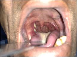 Image result for Sialolithiasis