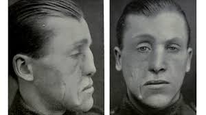 World War I Veterans Ravaged Faces Restored By Innovative Plastic Surgery History