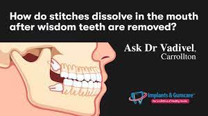 How Do Stitches Dissolve In The Mouth After Wisdom Teeth Are Removed Ask Dr Vadivel Carrollton Youtube