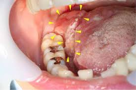 Image result for spinocellular carcinoma of the oral cavity