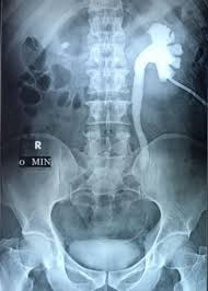 Sometimes, the kidney stone can travel down the ureter, the tube between the kidney and the bladder. Chain Of Migrating Ureteral Calculi A Cat And Mouse Game Bmj Case Reports