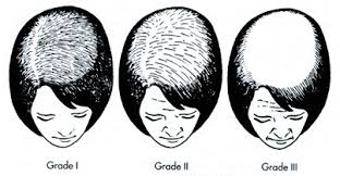 Check spelling or type a new query. Alopecia Androgenetica Bij Vrouwen Female Pattern Baldness Patientenfolder
