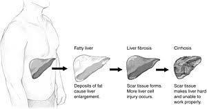 Learn more about this top honor Non Alcoholic Fatty Liver Disease Wikipedia