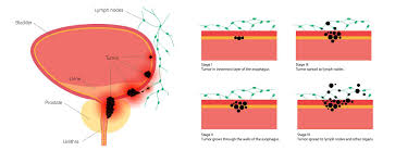 Image result for Bladder Cancer Staging