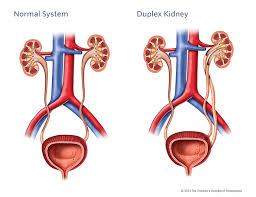 Duplex Kidney Kidney Kidney Infection Acute Renal Failure