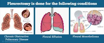 Surgery for malignant mesothelioma · to try to cure the cancer (potentially curative surgery) · to relieve pain and other symptoms caused by the . Pleurectomy Types Risks Complications
